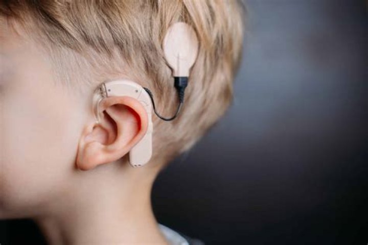 Are cochlear implants worth it