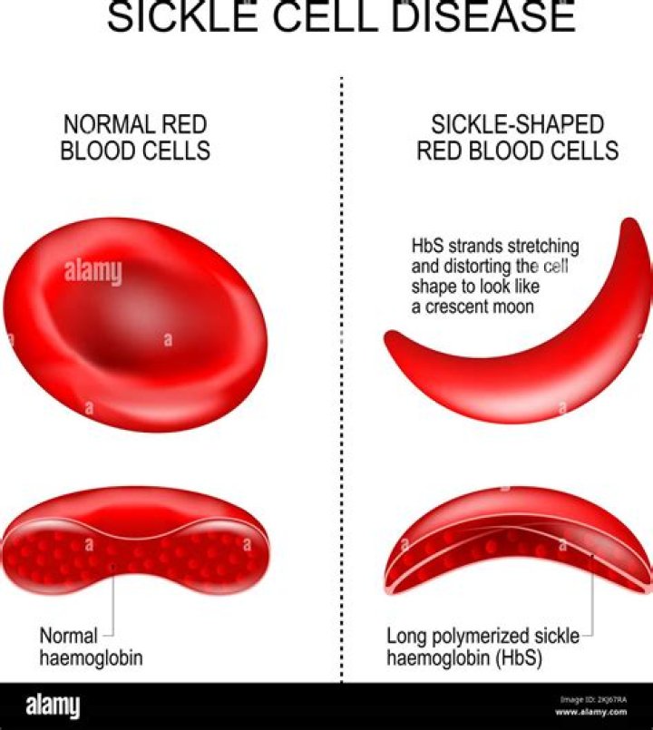 Are sickle cells sickle shaped