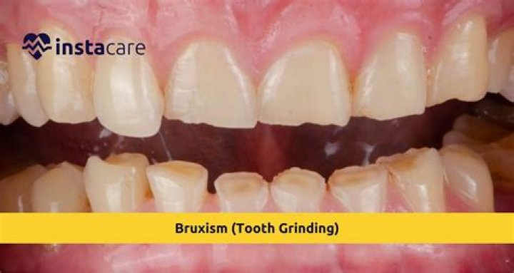 Can a tooth hurt from grinding