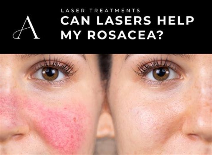 Can beta blockers help rosacea
