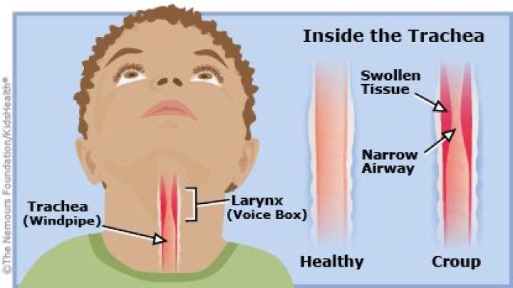 Can croup come out of nowhere