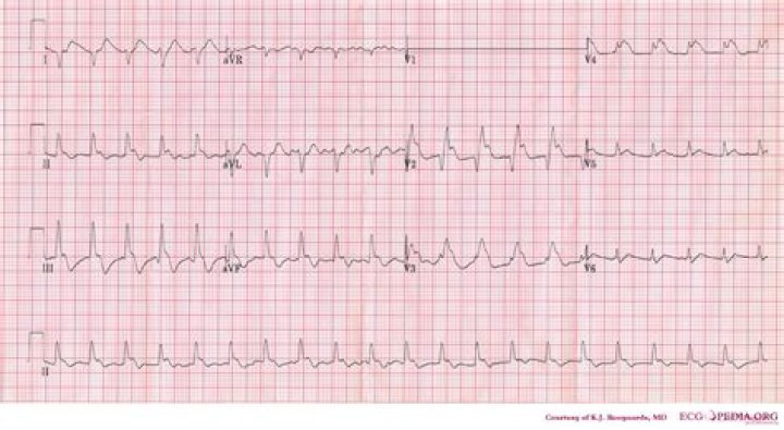 Can ECG detect pulmonary embolism