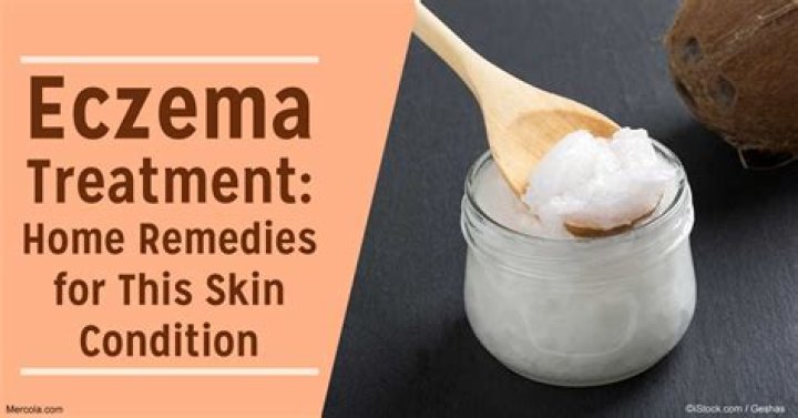 Can eczema Herpeticum be cured