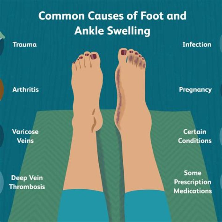 Can flying make your ankles swell