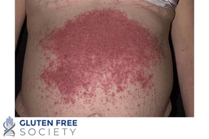 Can gluten cause bumps on skin