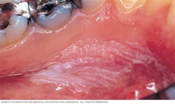 Can leukoplakia last for years
