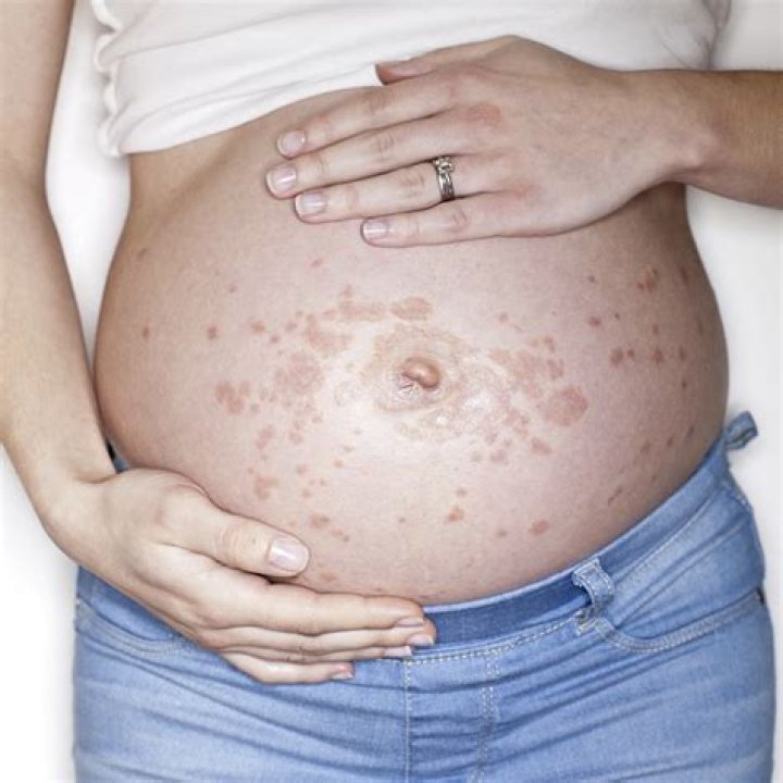 Can pregnancy cause Fordyce spots