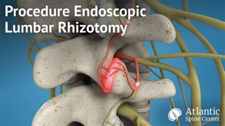 Can rhizotomy make pain worse