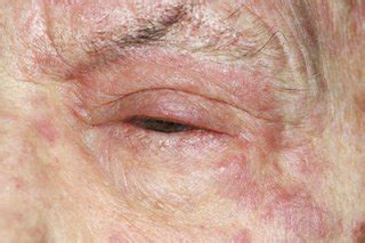 Can shingles affect both eyes