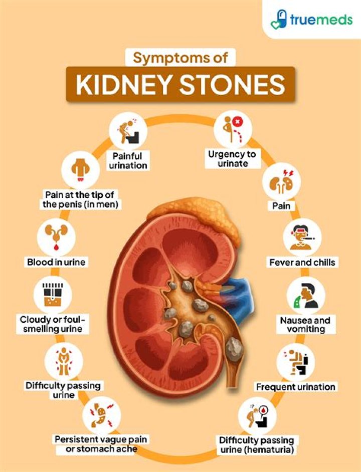 Can Sprite cause kidney stones