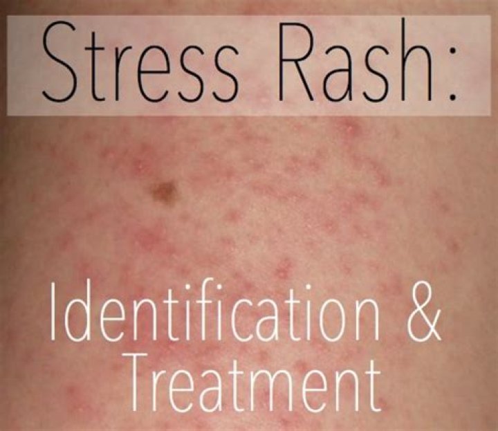 Can stress cause an itchy rash
