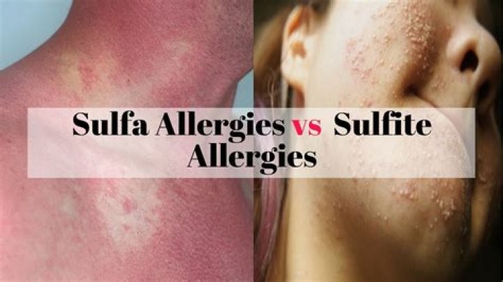 Can sulfites cause dermatitis