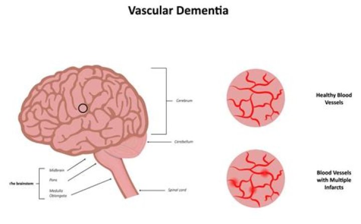 Can vascular dementia be cured