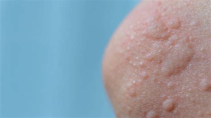 Can vitamins cause a skin rash