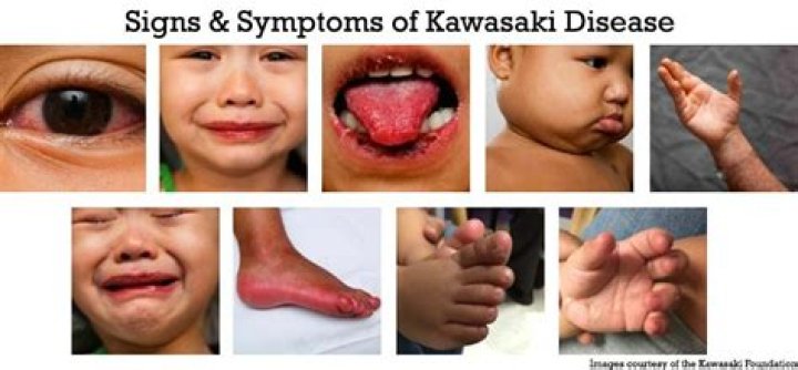 Can you beat Kawasaki disease