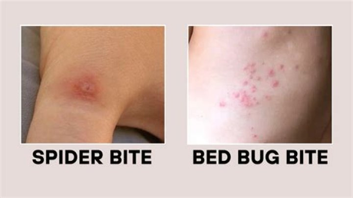 Can you get just one bed bug bite