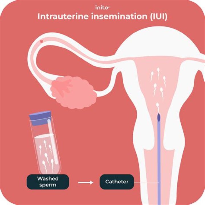 Can you pick gender with IUI