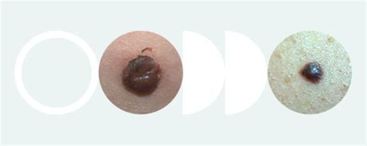 Can you pop a nodular melanoma