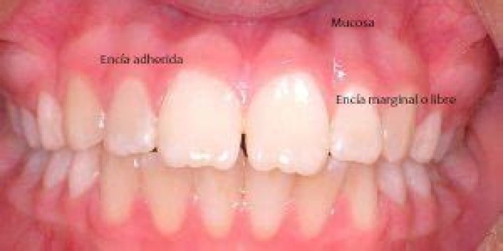 ¿Cuál es la línea mucogingival