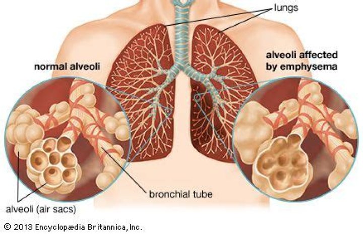 Do emphysema patients need oxygen
