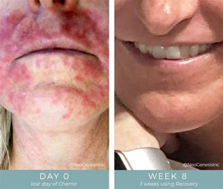 Does Chemo change your skin color