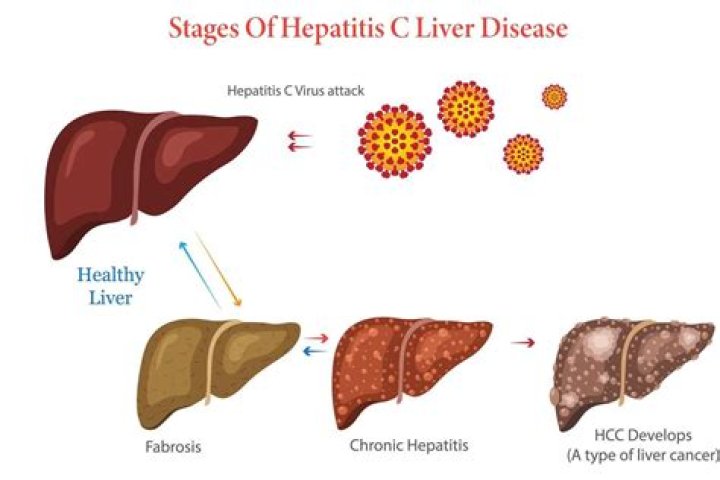 Does Hep C affect your spleen