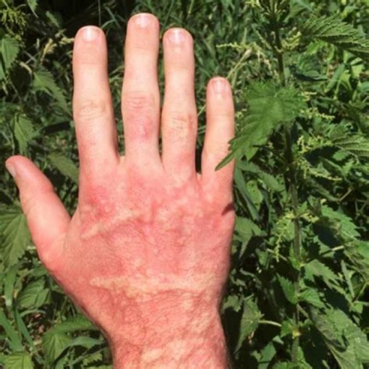 Does Stinging Nettle cause a rash