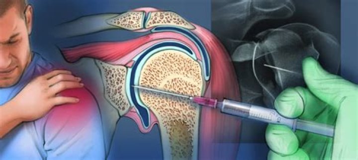 How big is an arthrogram needle