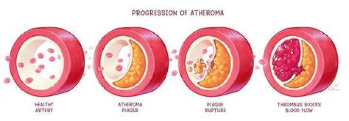 How can atheroma be prevented