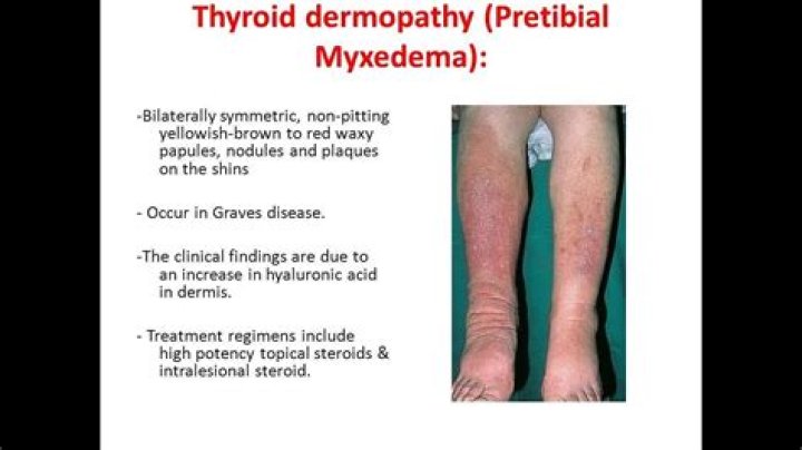 How do I know if I have Pretibial myxedema
