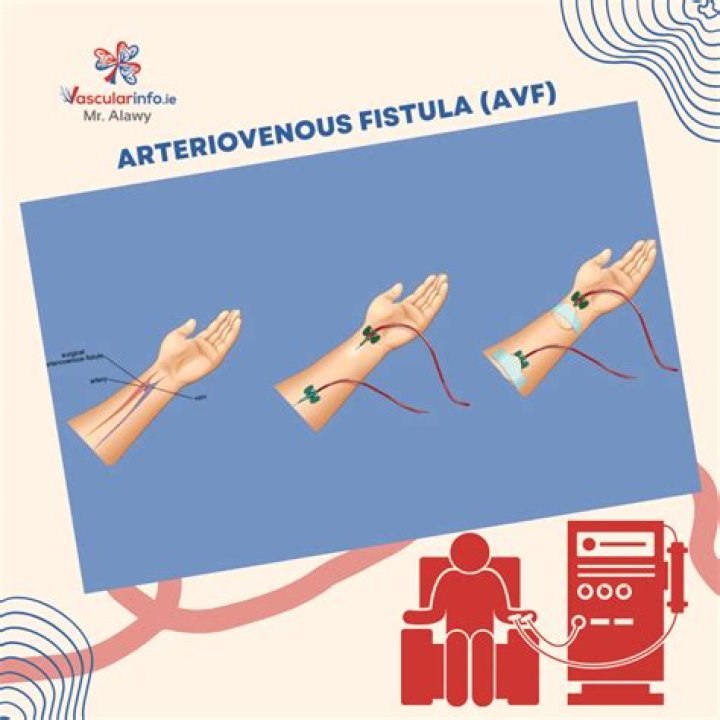 How do you code an AV fistula