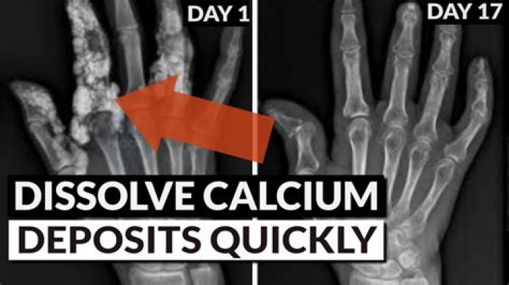 How do you fix bone calcification