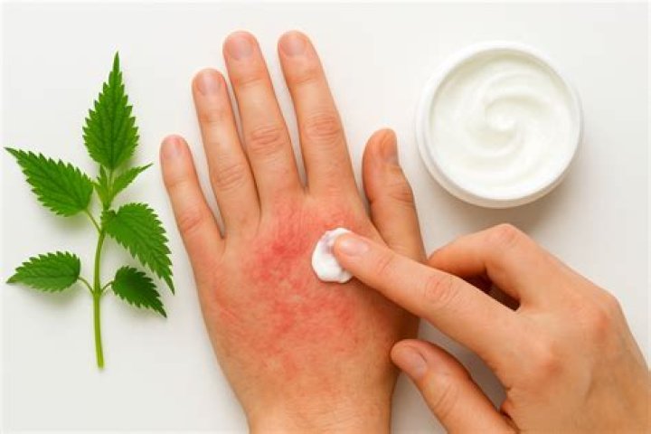 How do you get rid of nettle rash