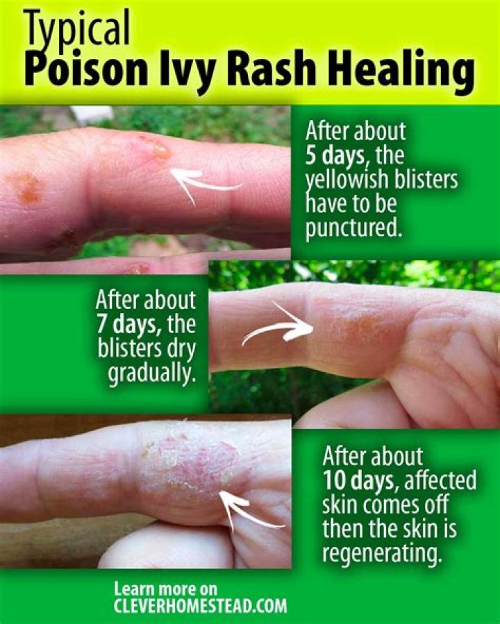 How do you know if poison ivy is healing