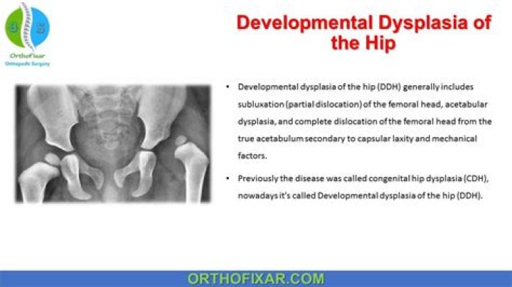 How do you test for hip dysplasia