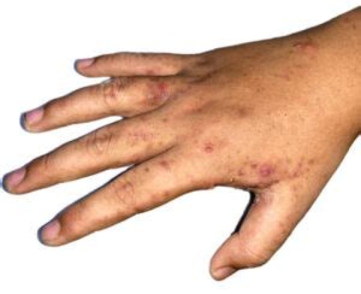 How do you use Kleen Free scabies