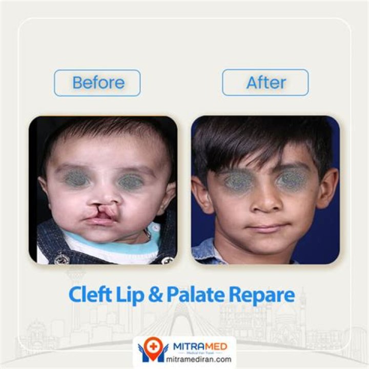 How is a cleft palate repair done