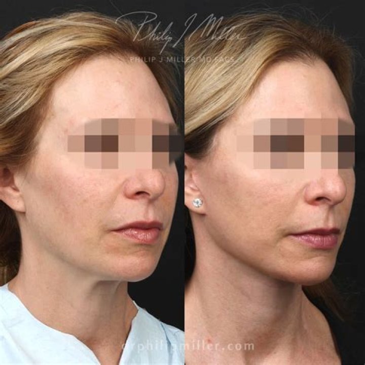 How is a mini face lift performed
