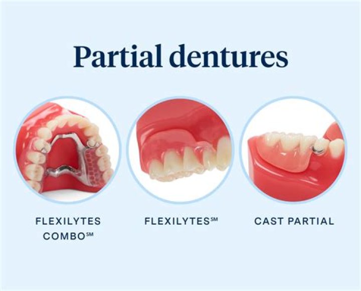 How is a partial denture attached