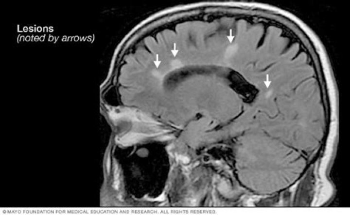 How is MS diagnosed on MRI