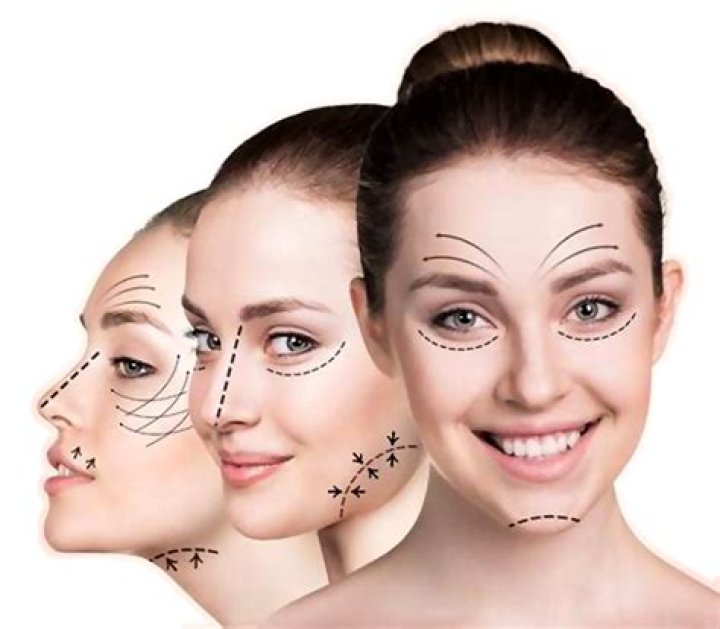 How long does lower facelift last