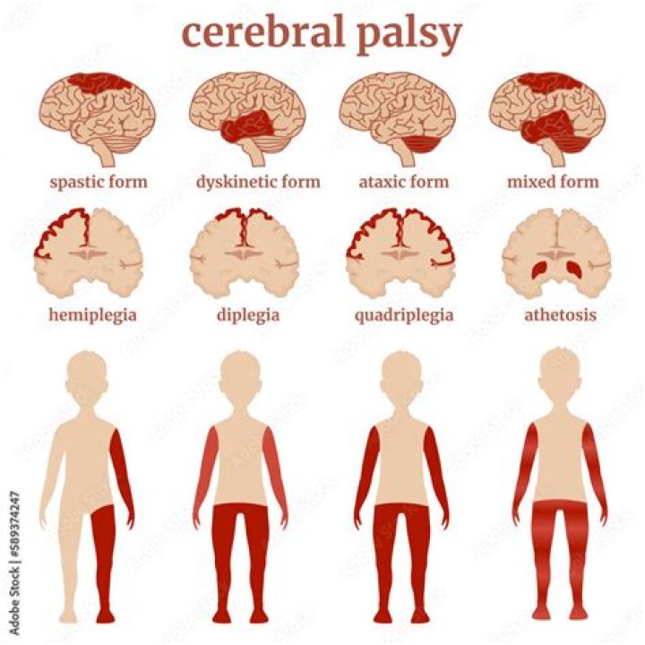 How many types of cerebral palsy are there