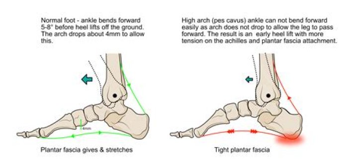 Is a Downgoing plantar normal