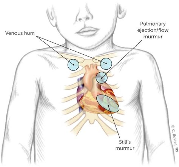 Is a Grade 4 heart murmur serious