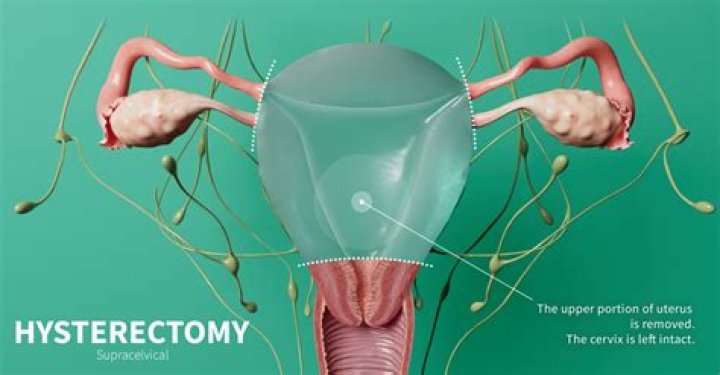 Is a hysterectomy a big operation