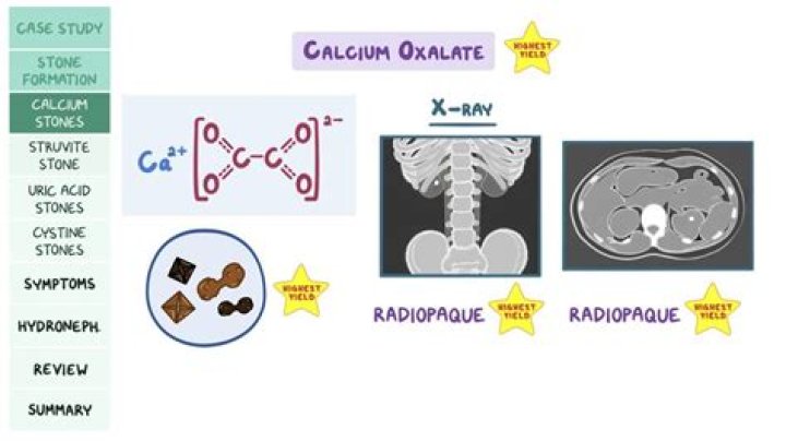 Is calcium oxalate radiopaque