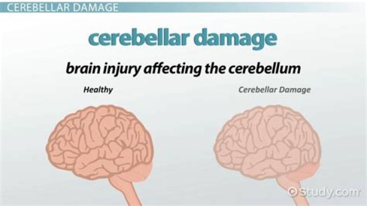 Is cerebellar degeneration fatal