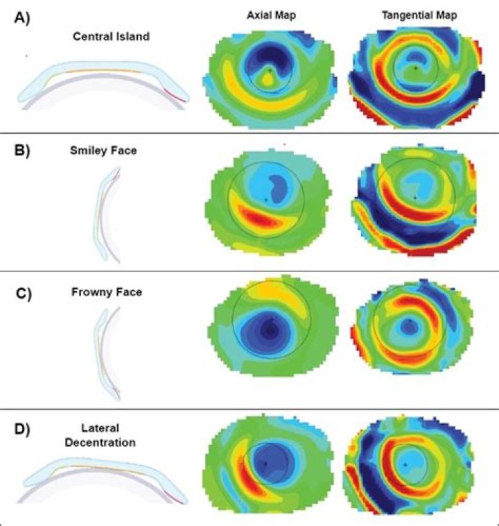 Is corneal topography painful