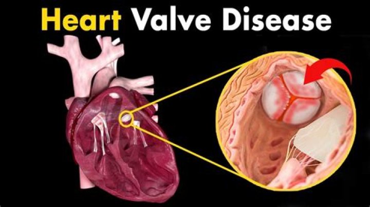 Is heart valve disease serious