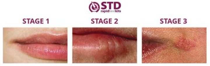 Is herpes a serious condition